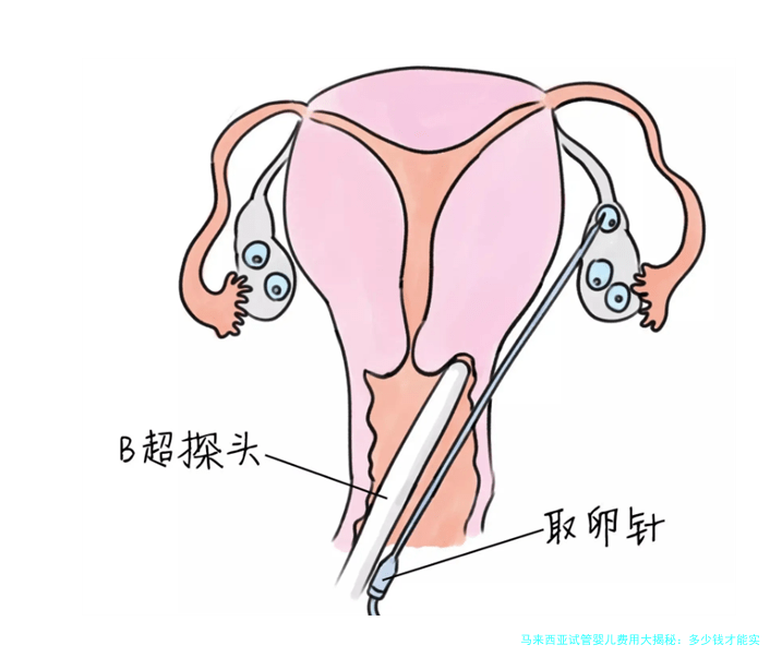 马来西亚试管婴儿费用大揭秘：多少钱才能实现生育梦？