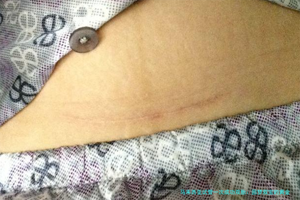 马来西亚试管一次成功双胎：圆梦双宝的黄金选择