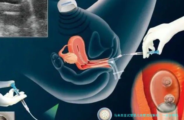 马来西亚试管婴儿完整流程解析：一步步带你了解助孕之路