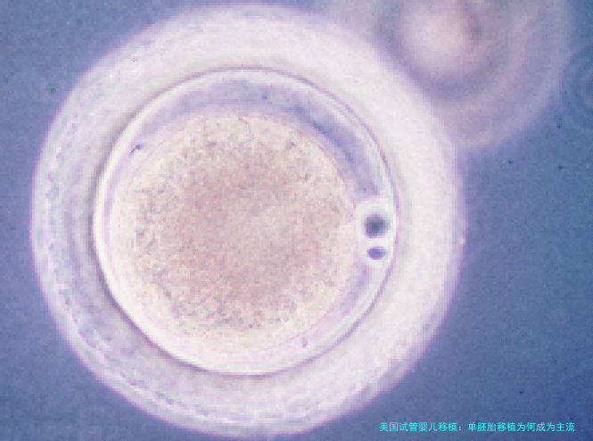 美国试管婴儿移植：单胚胎移植为何成为主流？