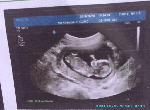 试管婴儿选择大PK：泰国与美国，哪个更值得你考虑？