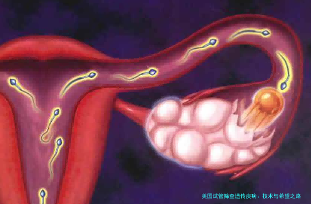 美国试管筛查遗传疾病：技术与希望之路