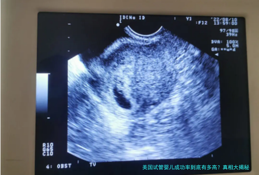 美国试管婴儿成功率到底有多高?真相大揭秘