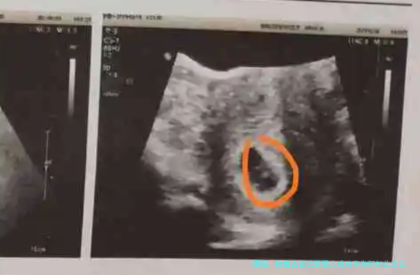 揭秘：格鲁吉亚试管婴儿成功率为何如此之低？