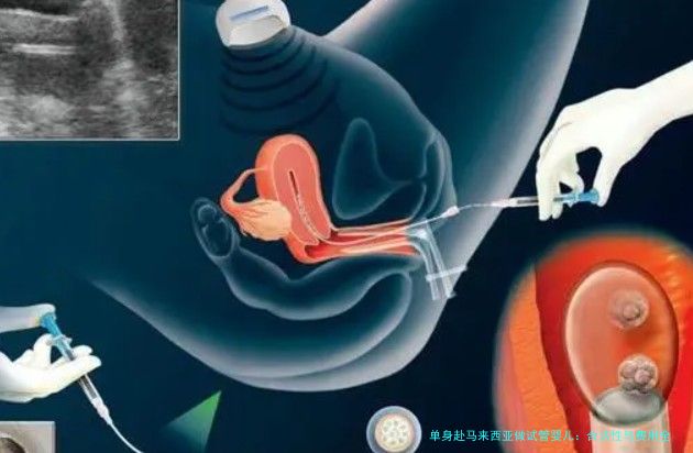 单身赴马来西亚做试管婴儿：合法性与费用全解析