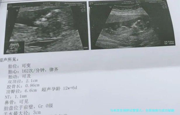 马来西亚捐卵试管婴儿：全面指南与成功秘籍