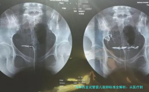 马来西亚试管婴儿取卵标准全解析：从医疗到患者条件的全面指南