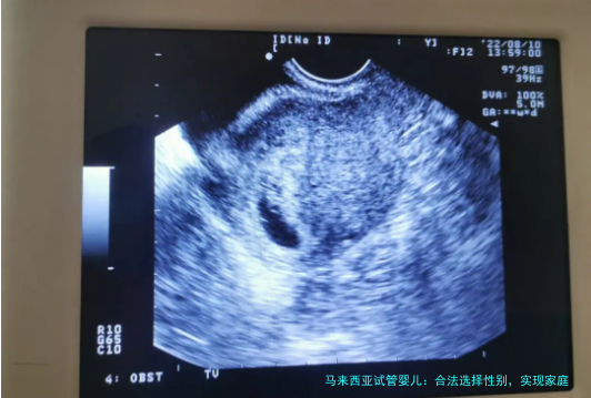 马来西亚试管婴儿：合法选择性别，实现家庭梦想？