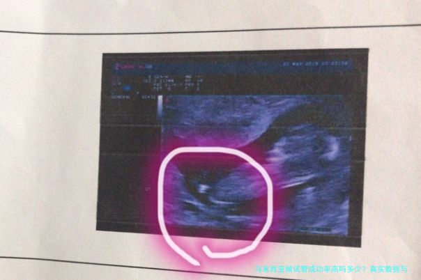 马来西亚做试管成功率高吗多少？真实数据与经验告诉你答案