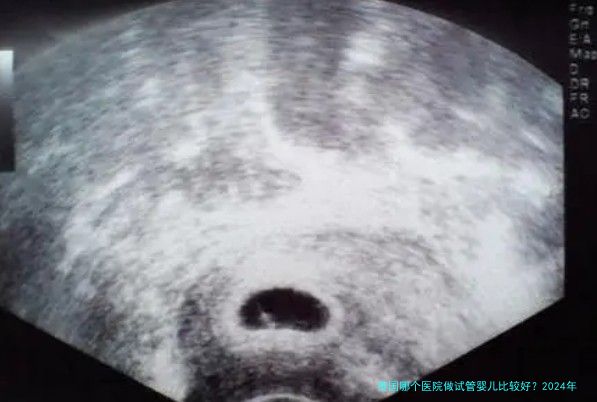 泰国哪个医院做试管婴儿比较好?2024年真实测评与推荐