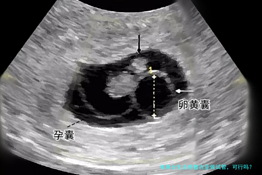 单身女生去格鲁吉亚做试管,可行吗?