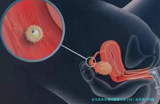 去马来西亚做试管婴儿多少钱？知乎热门问题一次说清