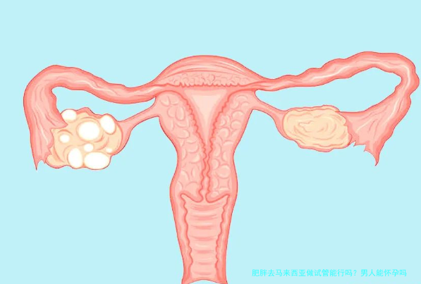 肥胖去马来西亚做试管能行吗？男人能怀孕吗？