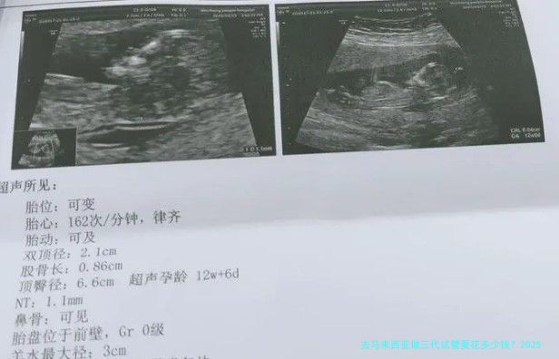 去马来西亚做三代试管要花多少钱？2025年真实费用明细+避坑经验