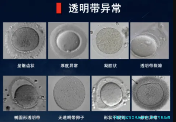 格鲁吉亚试管婴儿多少钱？2025年最新费用明细与避坑指南
