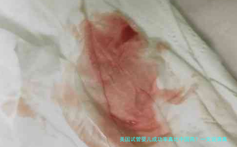 美国试管婴儿成功率真比中国高？一文说清真相