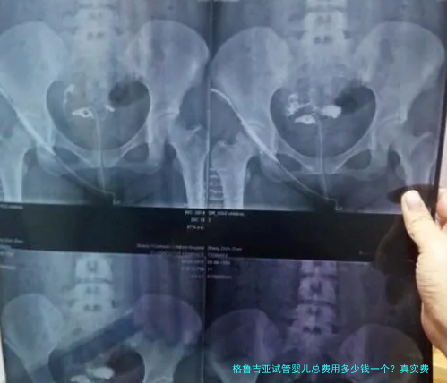 格鲁吉亚试管婴儿总费用多少钱一个?真实费用清单与省钱思路